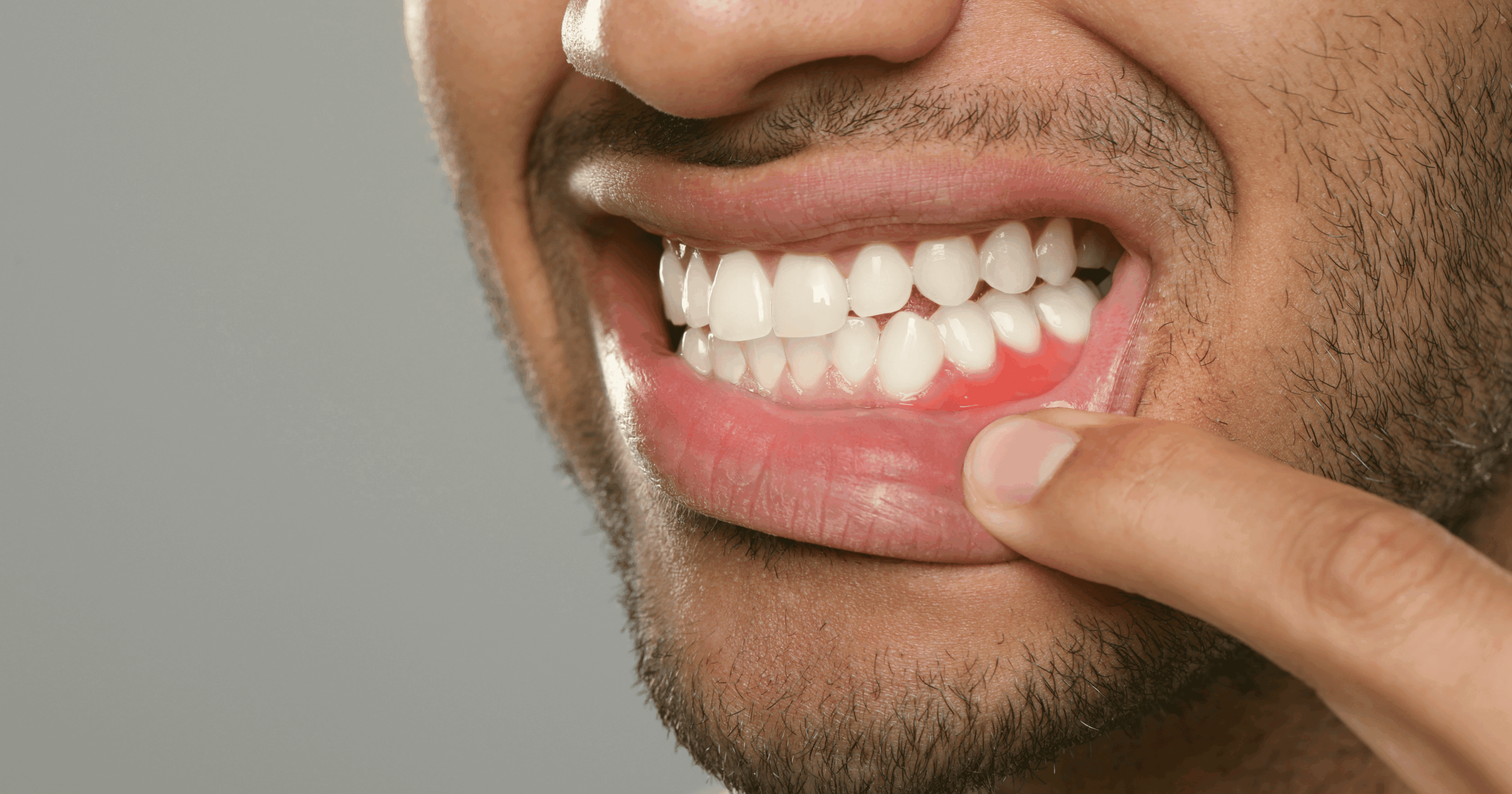Strong Link Between Gum Disease and Stroke Risk